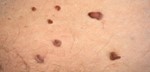 How To Remove Skin Tags