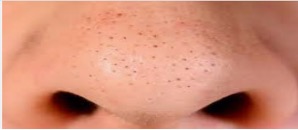 Know Blackheads And Whiteheads Natural Removal Remedies