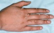 Get Rid Of Warts Naturally