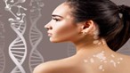 Know How To Treat Vitiligo (Leukoderma)