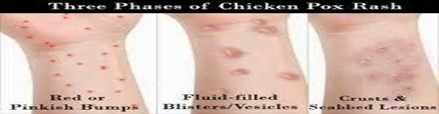 Chicken Pox Problem: Ayurvedic And Homeopathic Treatments