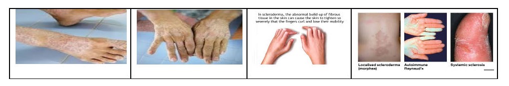 Ayurvedic And Homeopathic Remedies For The Management Of Scleroderma