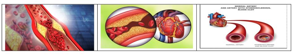 Know The Natural Treatments For Heart Blockages 