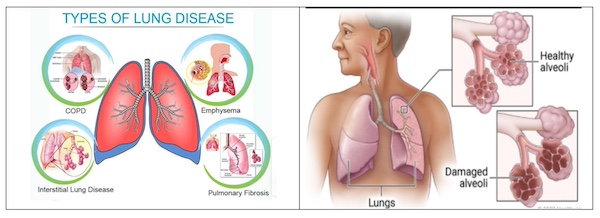 Raising Awareness About Lung Diseases