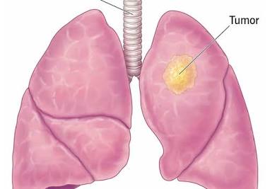 Poem: Ode To Lung Cancer Awareness