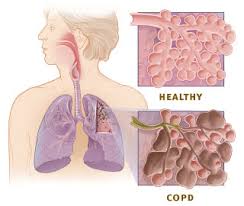 Every Breath Counts — A Poem On COPD Awareness