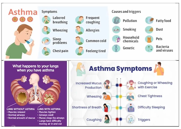 Understanding Asthma – Pathophysiology And Treatment
