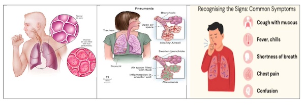 Pneumonia: A Look At A Common But Serious Illness