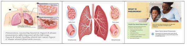 Pneumonia: The Silent Lung Infection Indian Must Not Ignore
