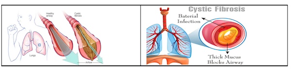 Cystic Fibrosis - A Silent Genetic Lung Disease People Should Know About