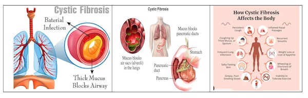 Cystic Fibrosis Through The Lens Of Ayurveda: An Ancient Understanding Of A Modern Lung Disorder