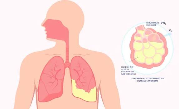 Chronic Bronchitis Through The Lens Of Ayurveda