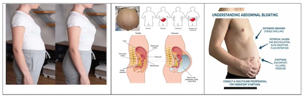 Upper Abdominal Bloating After Eating