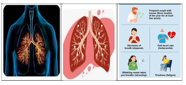 Understanding Bronchitis_ A Doctor Answers Your Frequently Asked Questions