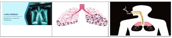 Lung Tissue Damage: Common Causes, Warning Signs, Effects On The Body And Treatment